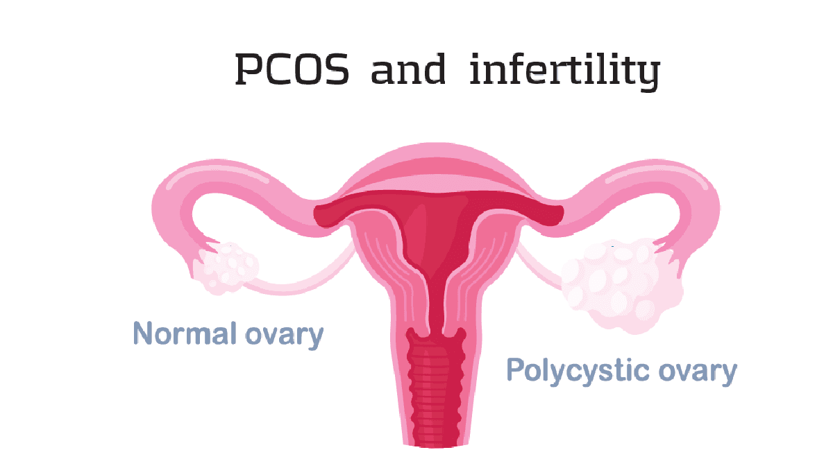 PCOS treatment in mumbai