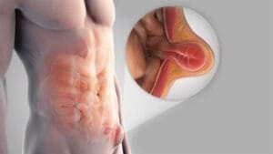Hernia Surgery in Mumbai
